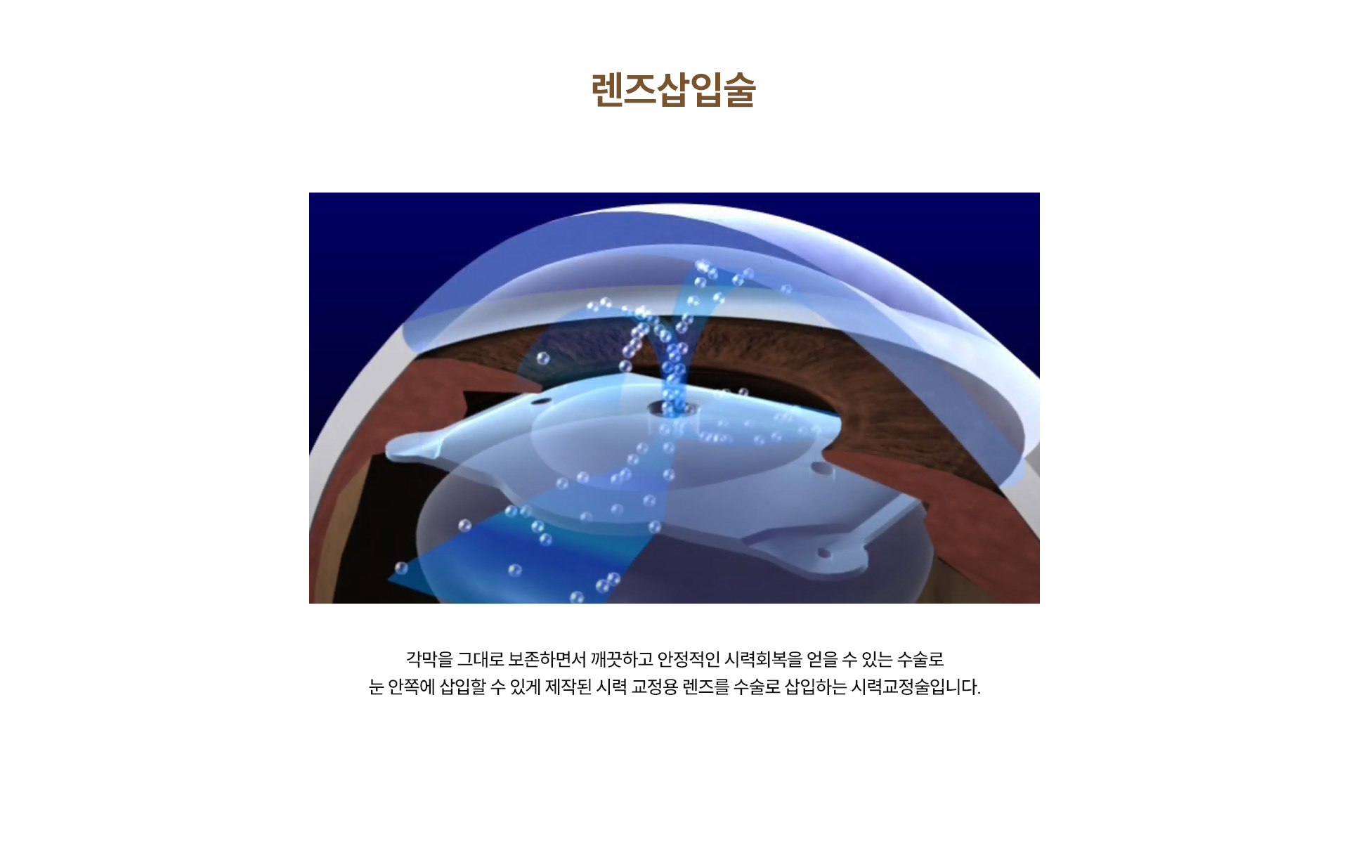 시력교정술 비교