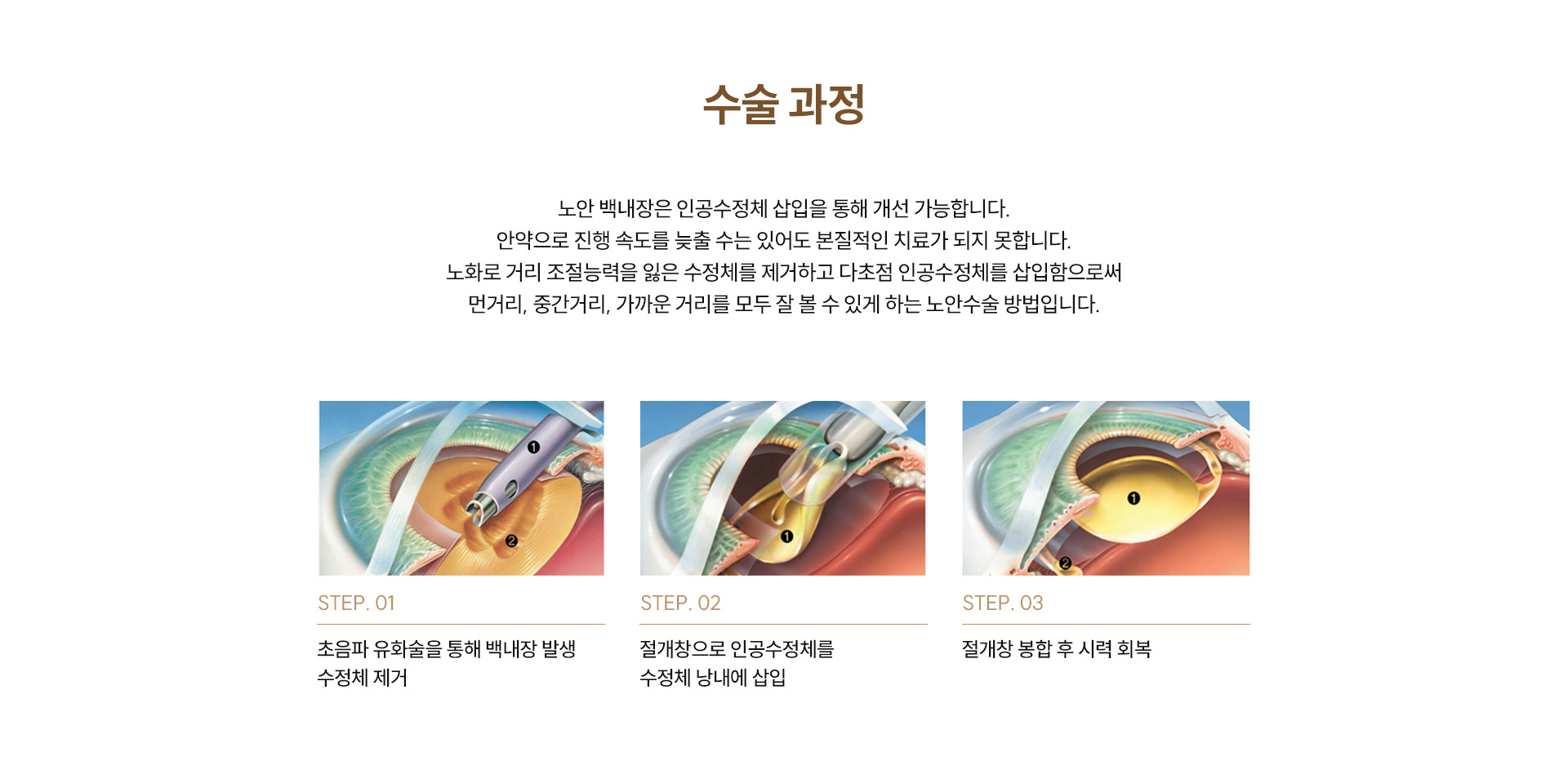 노안백내장수술