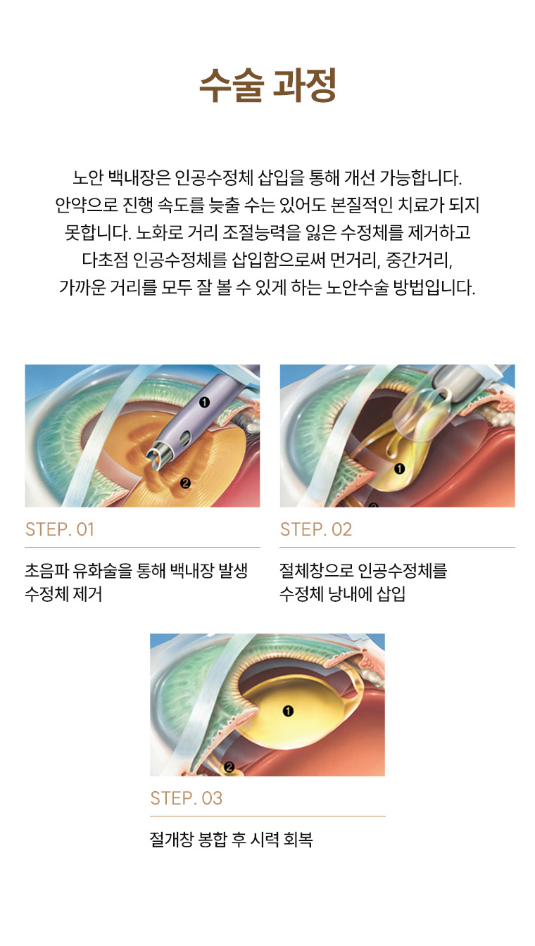 노안백내장수술