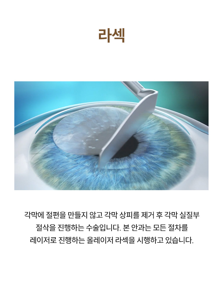시력교정술 비교