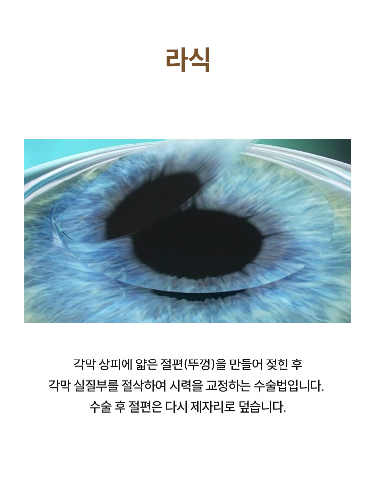 시력교정술 비교