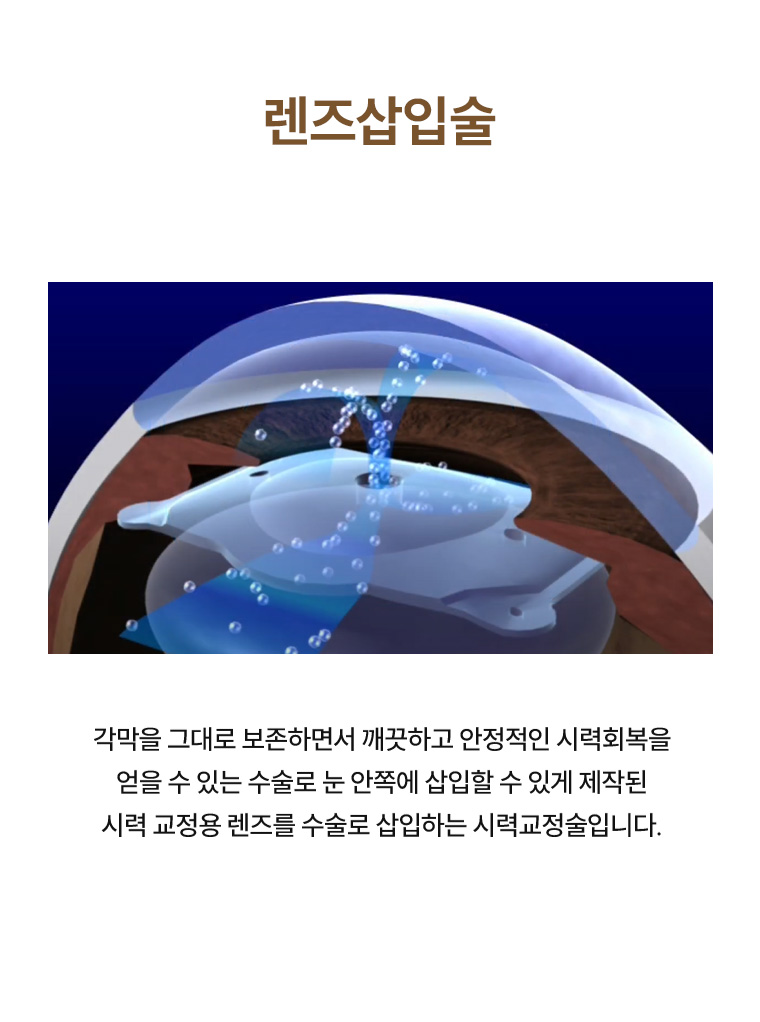 시력교정술 비교