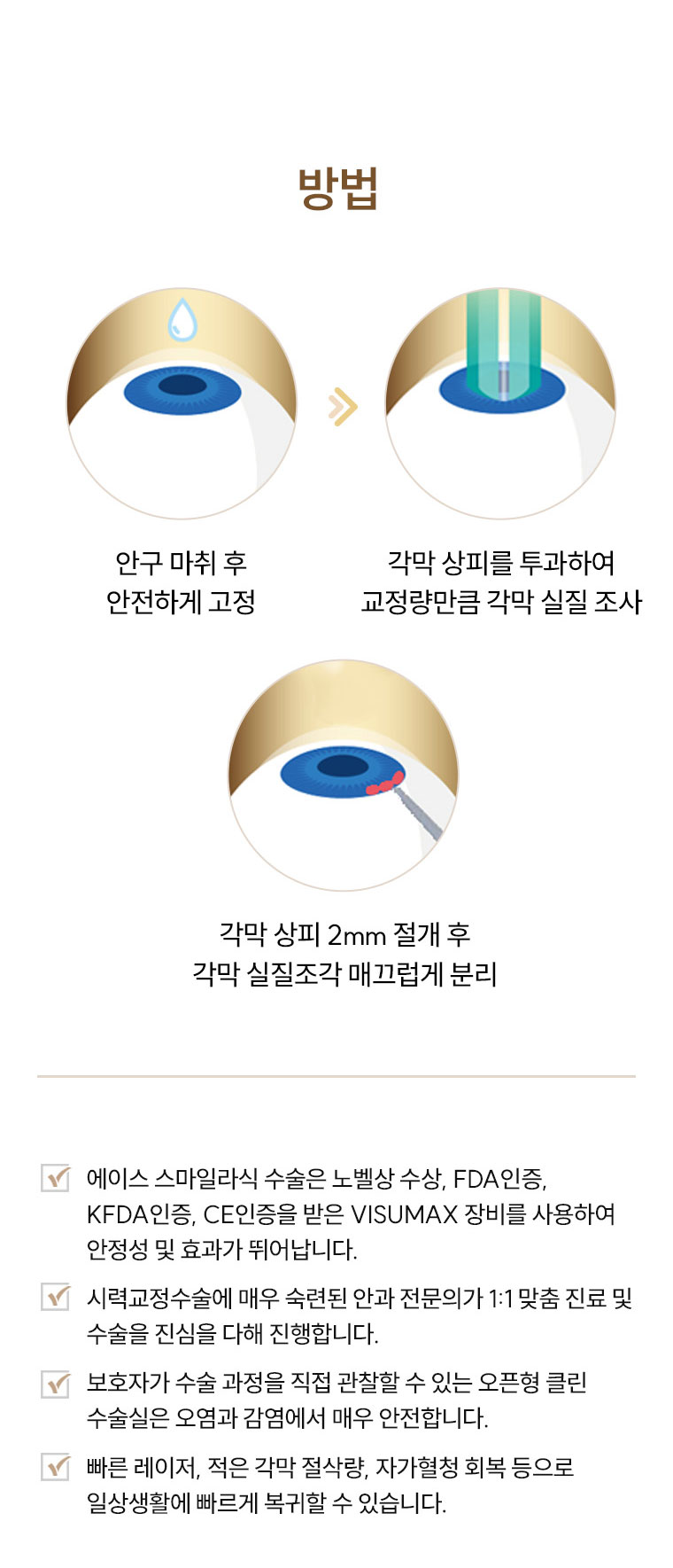 스마일라식