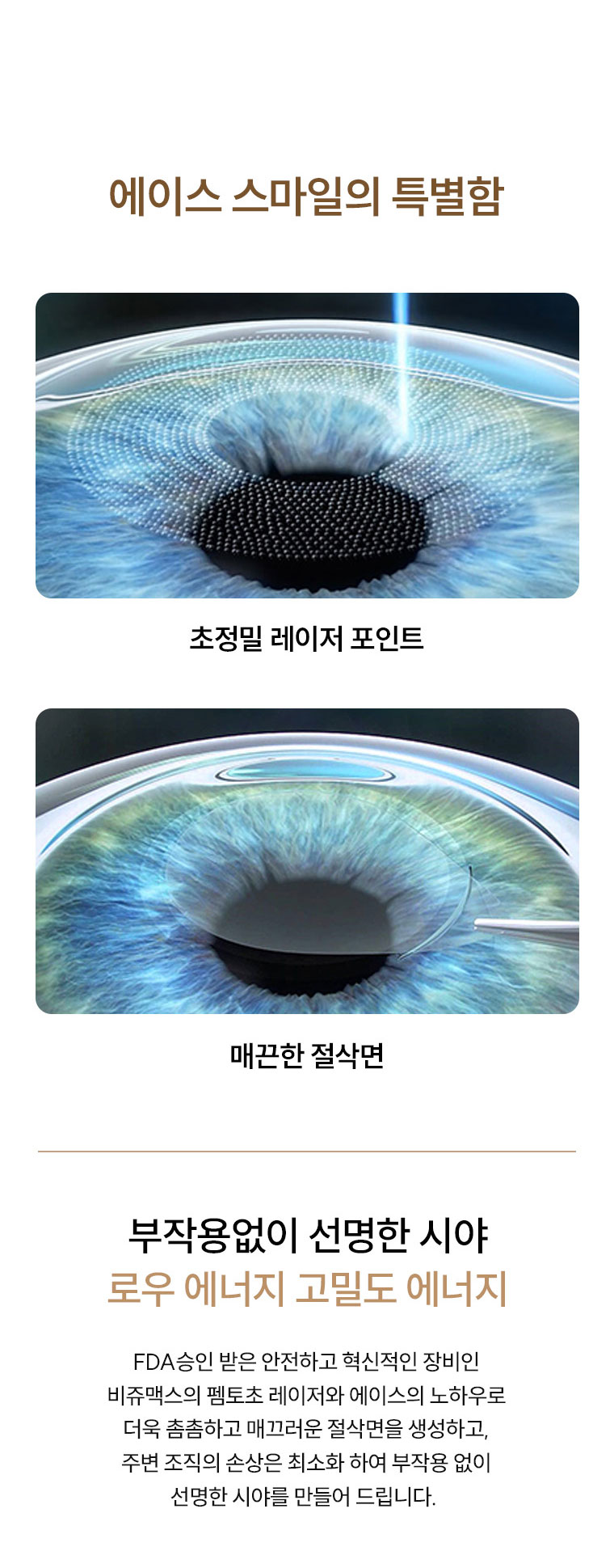 스마일라식