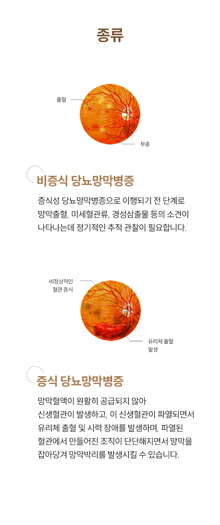 당뇨망막병증