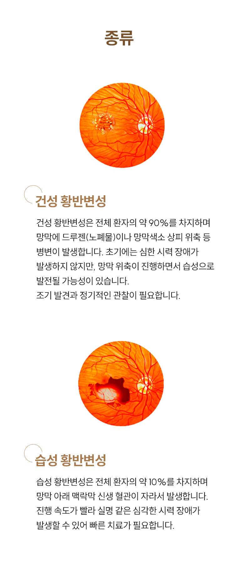 황반변성