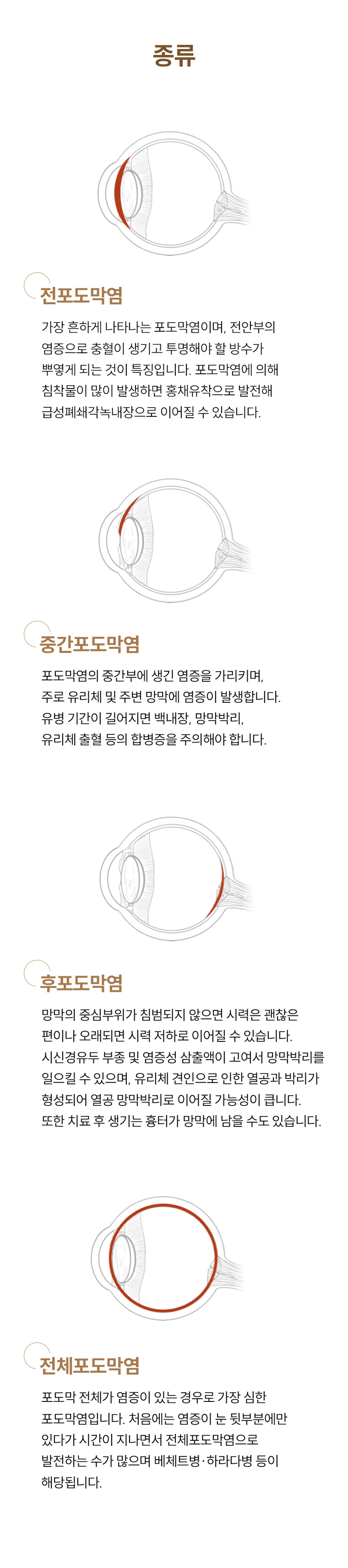 포도막엽