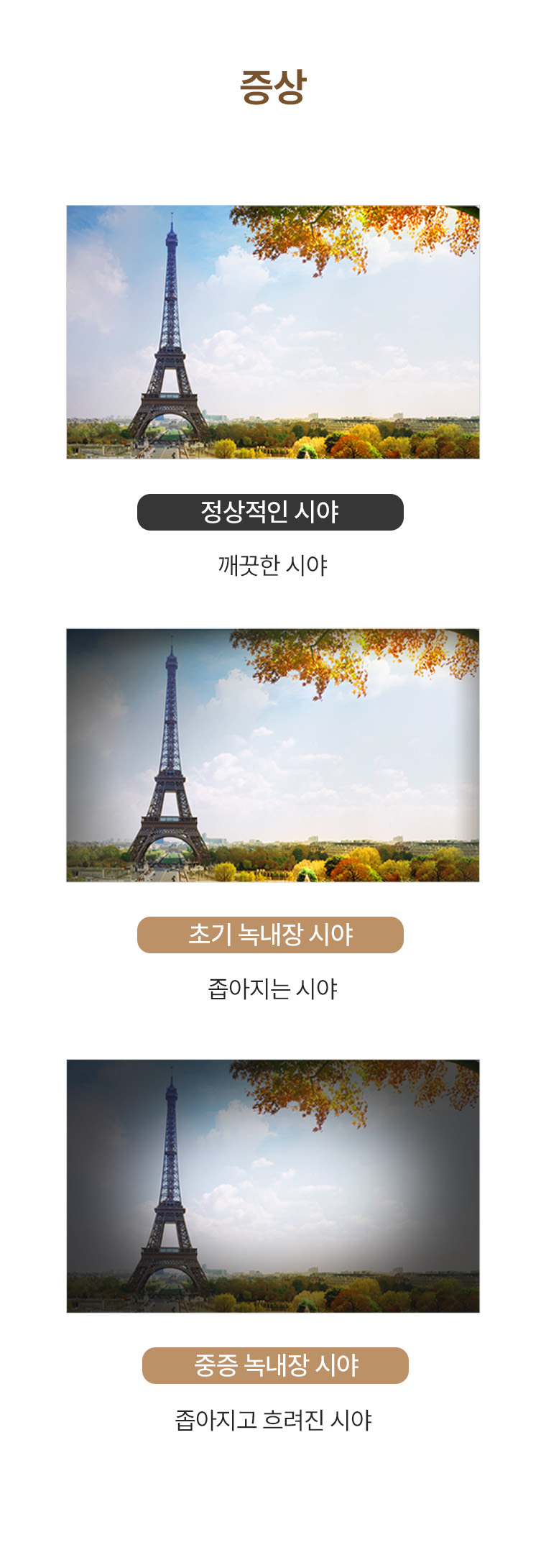 녹내장