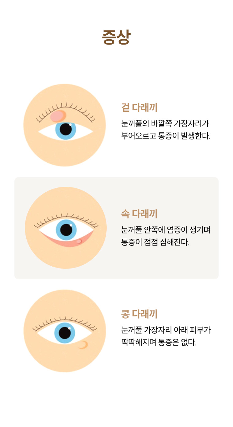 다래끼